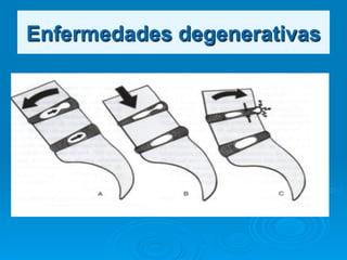 Enfermedades degenerativas
 