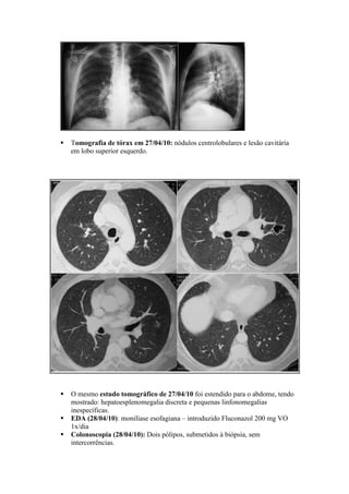 Tomografia de tórax em 27/04/10: nódulos centrolobulares e lesão cavitária
em lobo superior esquerdo.
O mesmo estudo tomográfico de 27/04/10 foi estendido para o abdome, tendo
mostrado: hepatoesplenomegalia discreta e pequenas linfonomegalias
inespecíficas.
EDA (28/04/10): monilíase esofagiana – introduzido Fluconazol 200 mg VO
1x/dia
Colonoscopia (28/04/10): Dois pólipos, submetidos à biópsia, sem
intercorrências.
 