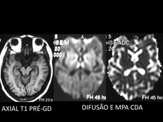 DIFUSÃO E MPA CDAAXIAL T1 PRÉ-GD