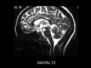 SAGITAL T2