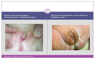 Recién nacido con hiperplasia adrenalcongénita, ambigüedad genitalMicropene con hipospadia, escroto bífido con hendidura mediaRadiographics 2008 Nov-Dec;28(7):1891-904 5