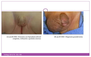 (A) 46,XX DSD—Femenina con hiperplasia adrenal congénita, virilización e genitalesexternos(B) 46,XY DSD—Disgenesia gonadal mixtaUrology 2010;75: 153–160