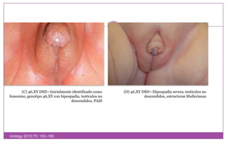 (C) 46,XY DSD—Inicialmenteidentificadocomofemenino, genotipo 46,XY con hipospadia, testículos no descendidos, PAIS(D) 46,XY DSD—Hipospadia severa, testículos no descendidos, estructurasMullerianasUrology 2010;75: 153–160