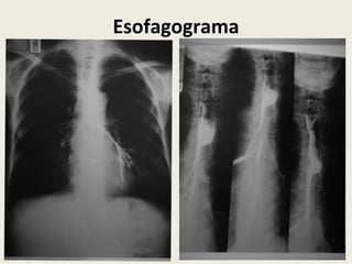 Esofagograma
 