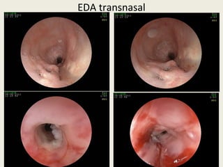 EDA transnasal
 