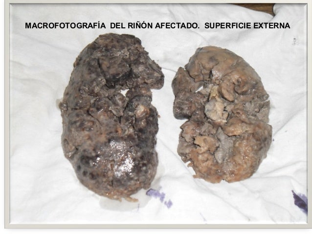 Resultado de imagen para riñon de un alcoholico
