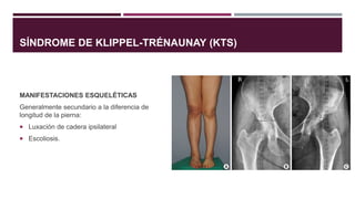 MANIFESTACIONES ESQUELÉTICAS
Generalmente secundario a la diferencia de
longitud de la pierna:
 Luxación de cadera ipsilateral
 Escoliosis.
SÍNDROME DE KLIPPEL-TRÉNAUNAY (KTS)
 