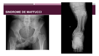 SINDROME DE MAFFUCCI
 