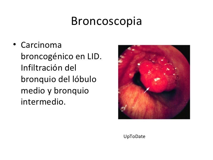 Caso clinico cancer de pulmon