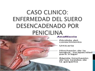 CASO CLINICO:ENFERMEDAD DEL SUERO DESENCADENADO POR PENICILINA 