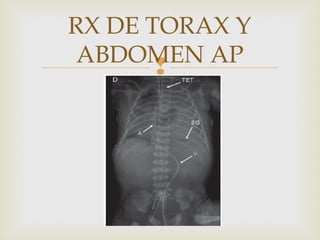 
RX DE TORAX Y
ABDOMEN AP
 