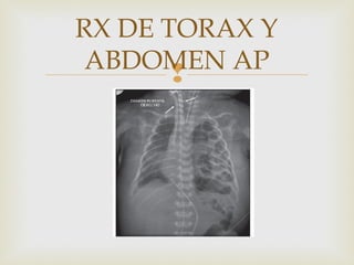 
RX DE TORAX Y
ABDOMEN AP
 