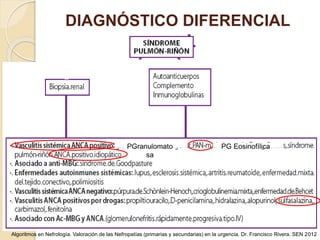 DIAGNÓSTICO DIFERENCIAL
Algoritmos en Nefrología. Valoración de las Nefropatías (primarias y secundarias) en la urgencia. Dr. Francisco Rivera. SEN 2012
PGranulomato
sa
PG Eosinofílica
 