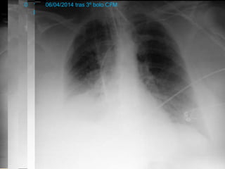 EVOLUCIÓN CLÍNICA PACIENTE
 Evolución PULMONAR:
◦ VMNI
◦ IOT (17/02/2014)
◦ Traqueostomía (19/03/2014)
◦ FBC  confirma hemorragia alveolar
16/02/201425/02/2014 tras CC01/03/2014 1º bolo CFM10/03/2014 tras
plasmaféresis
19/03/2014 tras 2º bolo
CFM
06/04/2014 tras 3º bolo CFM
 