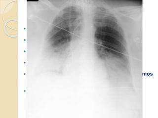 EVOLUCIÓN PACIENTE
 Evolución tórpida = 70 días ingreso en UMI
 Imposibilidad de destete respiratorio
 Necesidad de diálisis casi diaria
 Politransfusiones
 Múltiples infecciones por microorganismos
resistentes
 EXITUS 26/04/2014:
◦ Shock séptico
◦ Fallo multiorgánico
 