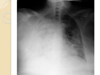  PC:
◦ Analítica:
 Hb 7’8 g/dL
 Leucocitos 15.300/mm3, neutrófilos 13.000./mm3
 Creatinina 8’93 mg/dL
 PCR 21’79 mg/L
◦ Test coombs directo: negativo
◦ EAB basal:
 pH 7’34, pCO2 33, PO2 33, HCO3 17’8, láctico 1’3
◦ Ag neumococo + legionella en orina: negativo
◦ Ag H1N1: negativo
◦ EKG: Rs. 66 lpm. Eje izquierda.
◦ Rx tórax
 