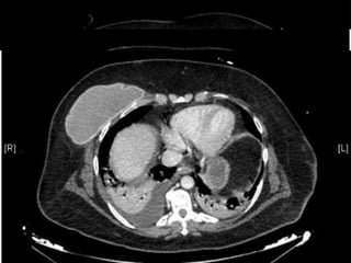 EVOLUCIÓN INICIAL UMI
 17/02/2014:
◦ IOT
◦ FBC: restos hemáticos en el interior del tubo y árbol bronquial
◦ Estudio autoinmune:
 Ig y complemento normales
 ANAs y ENAs negativos
 P-ANCA positivo título 1/320 (MPO > 134’0 U/ml)
 Ac anti-MBG + Ac SAF negativos
 Anti-DNAds 12’5
 VSG 141 mm
 Ac antiperoxidasa 1720’6 UI7ml
◦ Serologías:
 VHB, VHC, VIH, Sífilis  negativos
 VHS, VVZ, CMV, parvovirus  negativos
 18/02/2014:
◦ Ecocardiograma:
 VI con masa ligeramente aumentada + FE 55%
 No datos indirectos de aumento de PAP
◦ TC Tórax:
 