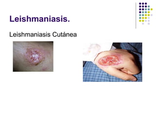 Leishmaniasis.
Leishmaniasis Cutánea
 