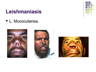 Leishmaniasis
 L. Mucocutanea.
 