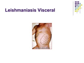 Leishmaniasis Visceral
 