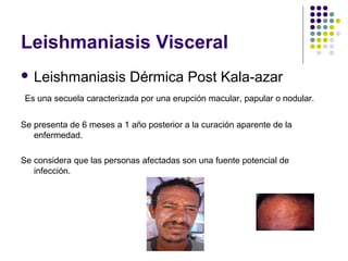 Leishmaniasis Visceral
 Leishmaniasis Dérmica Post Kala-azar
Es una secuela caracterizada por una erupción macular, papular o nodular.
Se presenta de 6 meses a 1 año posterior a la curación aparente de la
enfermedad.
Se considera que las personas afectadas son una fuente potencial de
infección.
 