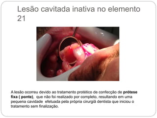 Lesão cavitada inativa no elemento
21
A lesão ocorreu devido ao tratamento protético de confecção de prótese
fixa ( ponte), que não foi realizado por completo, resultando em uma
pequena cavidade efetuada pela própria cirurgiã dentista que iniciou o
tratamento sem finalização.
 
