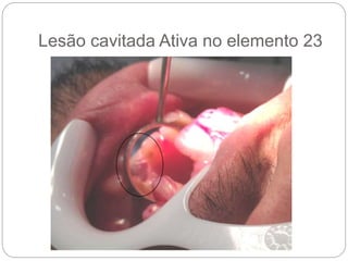 Lesão cavitada Ativa no elemento 23
 