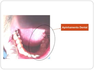 Apinhamento Dental
 