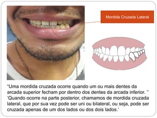 Mordida Cruzada Lateral
“Uma mordida cruzada ocorre quando um ou mais dentes da
arcada superior fecham por dentro dos dentes da arcada inferior. ’’
‘Quando ocorre na parte posterior, chamamos de mordida cruzada
lateral, que por sua vez pode ser uni ou bilateral, ou seja, pode ser
cruzada apenas de um dos lados ou dos dois lados.’
 