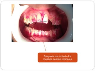 Desgaste nas incisais dos
incisivos centrais inferiores
 