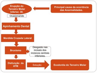 Apinhamento Dental
Mordida Cruzada Lateral
Bruxismo
Desgaste nas
incisais dos
incisivos centrais
inferiores.
Disfunção da
ATM Solução Exodontia do Terceiro Molar
Erupção do
Terceiro Molar
Inferior, 38.
Principal causa da ocorrência
das Anormalidades.
Ocasionando
 