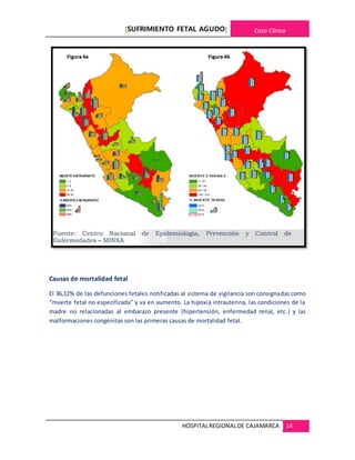 [SUFRIMIENTO FETAL AGUDO] Caso Clínico
HOSPITALREGIONALDE CAJAMARCA 14
Causas de mortalidad fetal
El 36,12% de las defunciones fetales notificadas al sistema de vigilancia son consignadas como
“muerte fetal no especificada” y va en aumento. La hipoxia intrauterina, las condiciones de la
madre no relacionadas al embarazo presente (hipertensión, enfermedad renal, etc.) y las
malformaciones congénitas son las primeras causas de mortalidad fetal.
 
