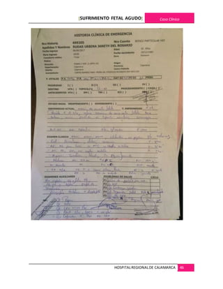 [SUFRIMIENTO FETAL AGUDO] Caso Clínico
HOSPITALREGIONALDE CAJAMARCA 46
 