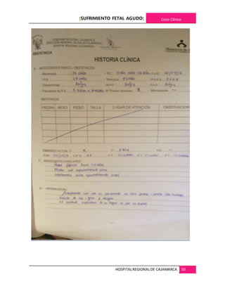 [SUFRIMIENTO FETAL AGUDO] Caso Clínico
HOSPITALREGIONALDE CAJAMARCA 50
 