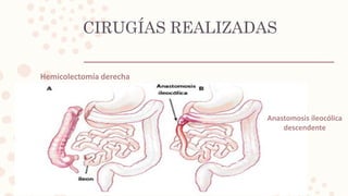 CIRUGÍAS REALIZADAS
Hemicolectomía derecha
Anastomosis ileocólica
descendente
 