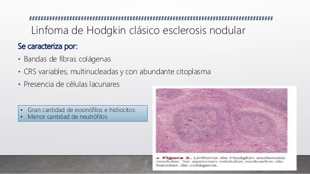 Caso clinico- linfoma Hodgkin