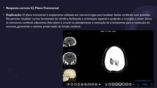 • Resposta correta: C) PlanoTransversal
• Explicação: O plano transversal é amplamente utilizado em neurocirurgias para localizar lesões cerebrais com precisão.
Ele permite visualizar cortes horizontais do cérebro, facilitando a orientação espacial e ajudando o cirurgião a evitar danos
às estruturas cerebrais adjacentes. Este plano é crucial no planejamento e execução de craniotomias para a ressecção de
tumores, garantindo a máxima preservação da função cerebral.
 