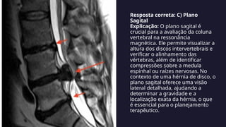 Resposta correta: C) Plano
Sagital
Explicação: O plano sagital é
crucial para a avaliação da coluna
vertebral na ressonância
magnética. Ele permite visualizar a
altura dos discos intervertebrais e
verificar o alinhamento das
vértebras, além de identificar
compressões sobre a medula
espinhal ou raízes nervosas. No
contexto de uma hérnia de disco, o
plano sagital oferece uma visão
lateral detalhada, ajudando a
determinar a gravidade e a
localização exata da hérnia, o que
é essencial para o planejamento
terapêutico.
 