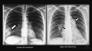 Joroba de Hampton Signo de Fleischner
 