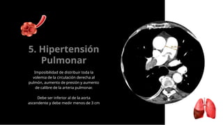 Imposibilidad de distribuir toda la
volemia de la circulación derecha al
pulmón, aumento de presión y aumento
de calibre de la arteria pulmonar.
Debe ser inferior al de la aorta
ascendente y debe medir menos de 3 cm
5. Hipertensión
Pulmonar
 