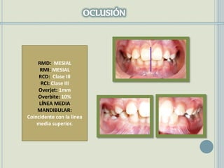 RMD: MESIAL
RMI: MESIAL
RCD: Clase III
RCI: Clase III
Overjet: 1mm
Overbite: 10%
LÍNEA MEDIA
MANDIBULAR:
Coincidente con la linea
media superior.
 