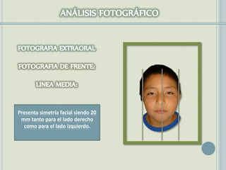 Presenta simetría facial siendo 20
mm tanto para el lado derecho
como para el lado izquierdo.
 