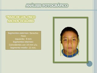 Segmentos externos: Derecho:
7mm
Izquierdo: 9 mm
Segmentos internos:
Coincidentes con 14 mm c/u.
Segmento medio: 15 mm.
 