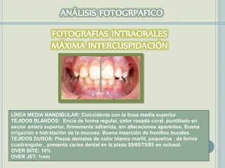 LÍNEA MEDIA MANDIBULAR: Coincidente con la linea media superior
TEJIDOS BLANDOS: Encía de forma regular, color rosado coral, puntillado en
sector antero superior, firmemente adherida, sin alteraciones aparentes. Buena
irrigación e hidratación de la mucosa. Buena inserción de frenillos bucales.
TEJIDOS DUROS: Piezas dentales de color blanco marfil, pequeños , de forma
cuadrangular , presenta caries dental en la pieza 55/65/75/85 en oclusal.
OVER BITE: 10%
OVER JET: 1mm
 