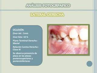 OCLUSIÓN:
Over-Jet : 1mm
Over bite: 10 %
Plano Terminal Derecho :
Mesial
Relación Canina Derecha :
Clase III
Se observa presencia de
placa en las piezas
posterosuperiores y
posteroinferiores
 