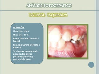 OCLUSIÓN:
Over-Jet : 1mm
Over bite: 10 %
Plano Terminal Derecho :
Mesial
Relación Canina Derecha :
Clase III
Se observa presencia de
placa en las piezas
posterosuperiores y
posteroinferiores
 