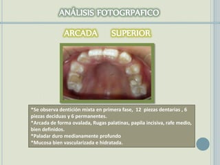 *Se observa dentición mixta en primera fase, 12 piezas dentarias , 6
piezas deciduas y 6 permanentes.
*Arcada de forma ovalada, Rugas palatinas, papila incisiva, rafe medio,
bien definidos.
*Paladar duro medianamente profundo
*Mucosa bien vascularizada e hidratada.
 