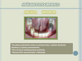 *Se observa dentición mixta en primera fase, 6 piezas dentarias
deciduas y 6 piezas permanentes.
*Piso de boca medianamente profunda
*Mucosa bien vascularizada e hidratada
 