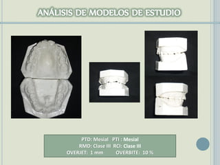 PTD: Mesial PTI : Mesial
RMD: Clase III RCI: Clase III
OVERJET: 1 mm OVERBITE: 10 %
 