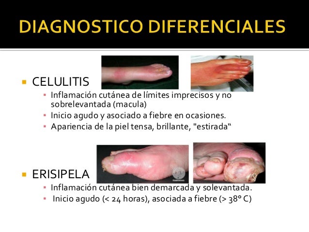 Caso clinico. pie diabetico Caso clinico. pie diabetico